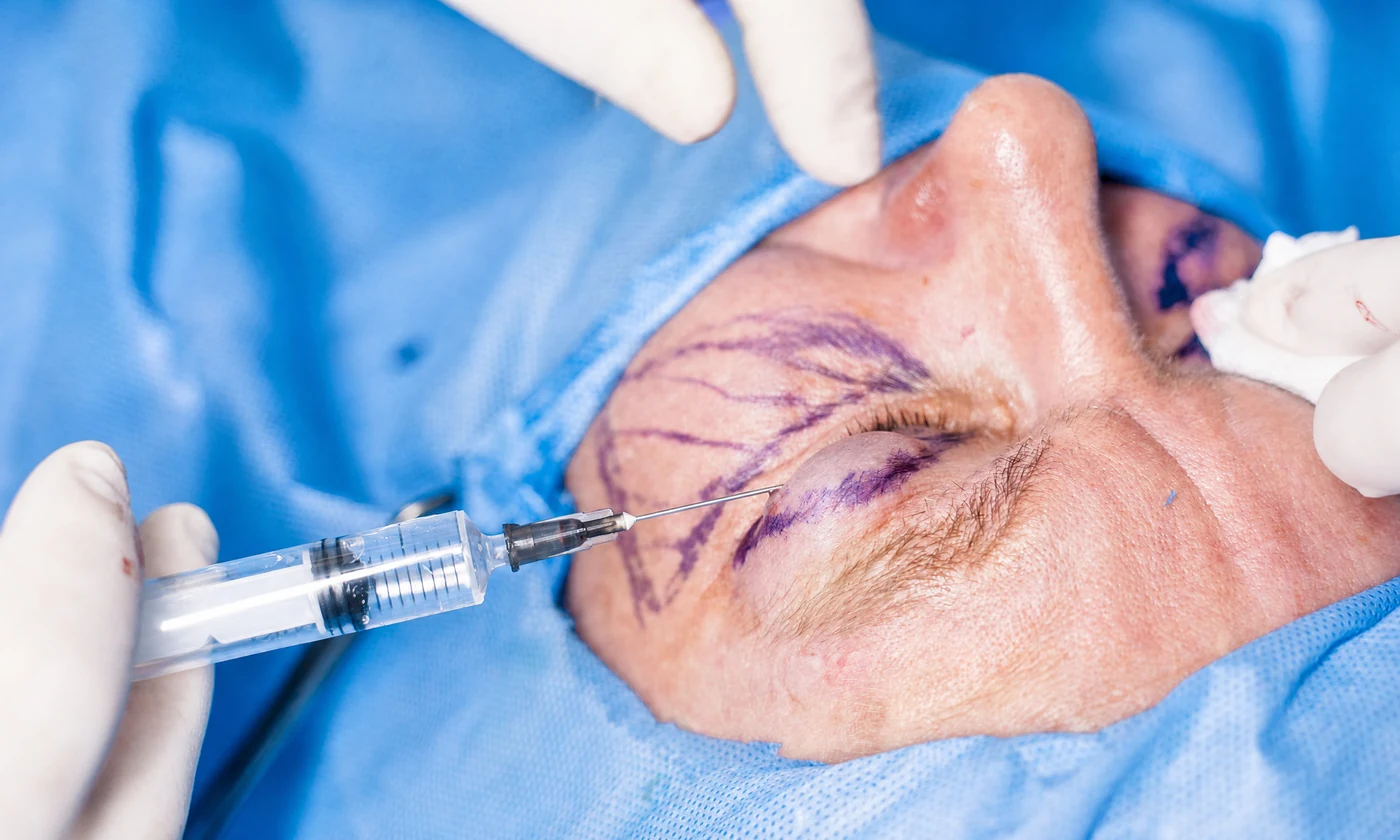 Blefaroplastia