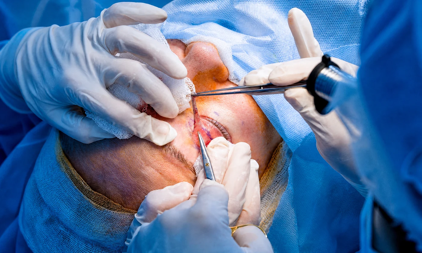 Cirugía de Ptosis Palpebral